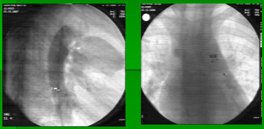 рентгенэндоваскулярная окклюзия ОАП спиралью Гиан-Турко